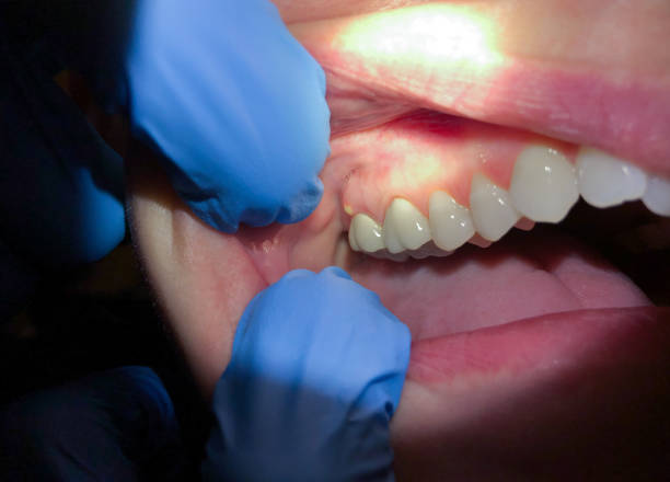 Best Emergency Dentist for Knocked-Out Tooth in East Pasadena, CA